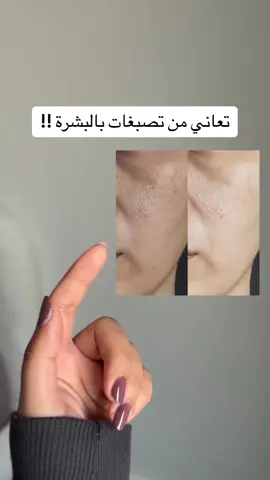 كريم acm لعلاج التصبغات 😨✨! #عشبة_وزيت #اكسبلور_تيك_توك #عناية_بالبشرة #عروسه #اكسبلورexplore #اكسبلوررررر #اكسبلور؟ #كولاجين 