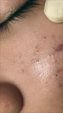 #pimplepoppersatisfying #pimple #acne #whiteheads 