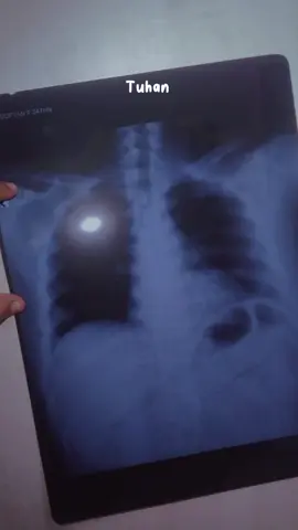 Tepat 1 Thn Berlalu, Berjuang Melawan Sakit ini, Harus Rutin Obat, dan Alhamdulillah, Masih Bertahan Sampai Saat ini. #CapCut #telahberjuangmelawansakitparuparu  #muhasabahcinta #fyp #sembuh 