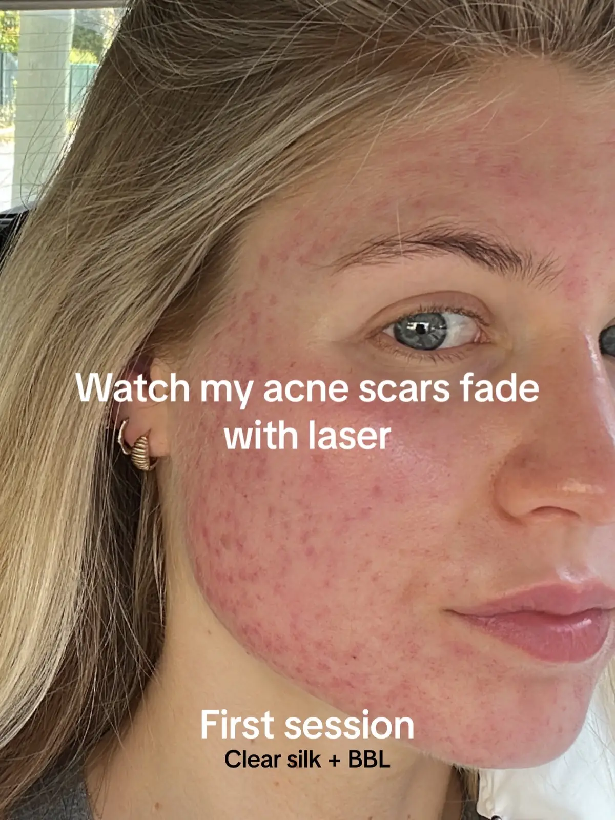 Me 🤝 laser  Once my acne cleared I was left with RUDE box scaring and so much PIE (post inflammatory erythema)(redness).  Although I stand by “time is the best healer”, laser really helped me speed the process up!!!  In my opinion I think laser is a FAR BETTER treatment for acne scaring than skin needling for severe acne scaring like mine. This is because laser protocals can be asjusted to suit your individualised skin concers producing more drastic results. Skin needling also poses a higher risk of skin barrier damange. However I’ve seen great reaults for both skin needling and laser. Make sure you do your research and your clinician/dermatologist is expereinced as both are a costly investment (with high reward).  Also my eyebrows have been ON A JOURNEY lol #bbllaser #clearsilklaser #picolaser #moxilaser #acnescars #acnetreatment #fyp #foryou #skinneedling #skincare #acne #acneproneskin 