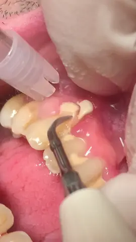 🪥🦷😱 #teeth #dentistry #dentist #dentistryworld #dentista #tartaros_team #dentalcalculus #scaling 