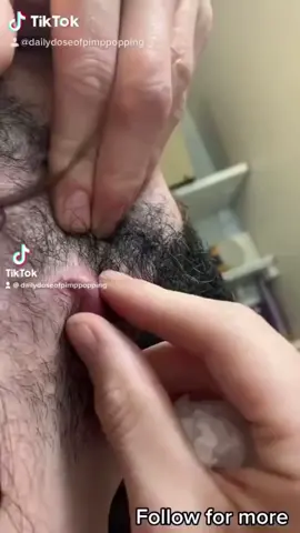 Do you remember this one? #pimple #fyp #satisfying #pop 