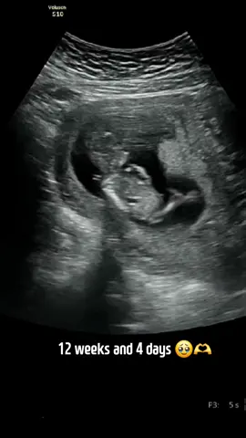can't wait to hold you! 🤍 #12weekspregnant #ultrasound #pregnant 