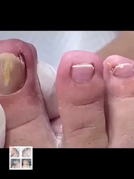 #toenails #ingrowntoenail #toenailremoval #nails #toenail #satisfying #foryou 46
