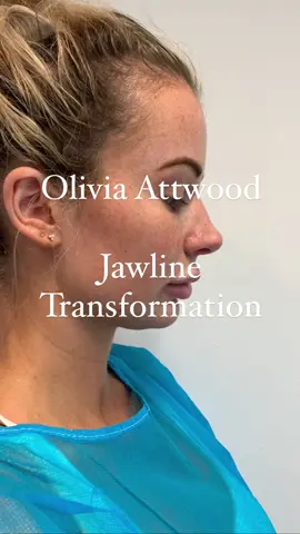 Liposuction and radiofrequency contouring of the jawline with my signature treatmenr #Jawtite  @Olivia jade attwood  #oliviaattwood #doublechin #liposuction #doublechinlipo #facetite #jawline 