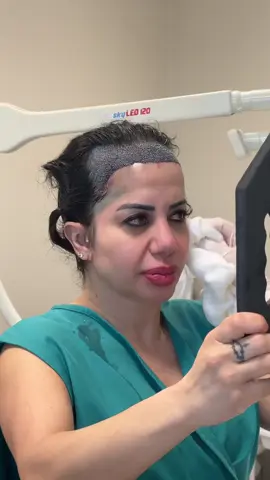 Transplante Capilar Feminino ❤️  #transplantecapilar #fue #estetica #cirurgia #calvice #cabelo #capilar #tratamento #pravoce #feminino #fy #foryou #hairtransplant 