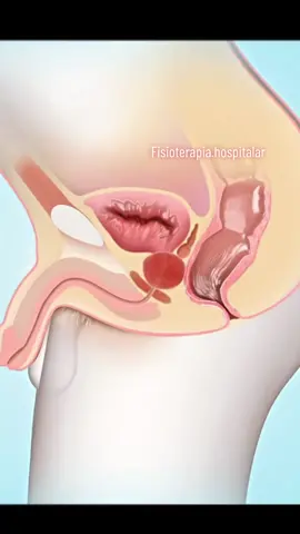 O câncer de próstata é um tipo de câncer que se desenvolve na próstata, uma glândula no sistema reprodutor masculino. É um dos tipos mais comuns de câncer em homens, mas muitas vezes cresce lentamente e pode não causar problemas de saúde significativos. No entanto, em alguns casos, pode se espalhar para outras partes do corpo, tornando-se mais perigoso. Os sintomas do câncer de próstata podem incluir dificuldade em urinar, dor ao urinar, sangue na urina ou sêmen, disfunção erétil, dor nas costas, quadris ou pelve, entre outros. No entanto, esses sintomas também podem ser causados por outras condições, como hiperplasia prostática benigna (HPB), por isso é importante consultar um médico para obter um diagnóstico preciso. O tratamento para o câncer de próstata pode incluir vigilância ativa (observação regular sem tratamento imediato), cirurgia, radioterapia, terapia hormonal, quimioterapia ou imunoterapia, dependendo do estágio e da agressividade do câncer. O tratamento ideal é determinado por um oncologista ou urologista, levando em consideração vários fatores, como a idade e a saúde geral do paciente, o estágio do câncer e suas preferências pessoais. #cancerdeprostata #prostata #prostataaumentada #fisio 