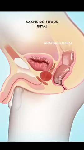O exame de toque retal é um procedimento realizado por um médico para avaliar o tamanho, a forma e a textura da próstata. Durante o exame, o médico insere um dedo lubrificado no reto do paciente para sentir a parte posterior da próstata, que está localizada logo abaixo da bexiga.  Embora possa ser desconfortável para alguns homens, o exame de toque retal é uma parte importante do rastreamento do câncer de próstata, pois pode ajudar a identificar anormalidades na próstata que podem indicar a presença de câncer. No entanto, o exame de toque retal não é o único método de rastreamento para o câncer de próstata. Outros testes, como o exame de sangue PSA (antígeno prostático específico), também são utilizados para ajudar a detectar o câncer de próstata. É importante discutir com o seu médico sobre os riscos e benefícios do exame de toque retal e de outros testes de rastreamento para o câncer de próstata, especialmente se você tem preocupações ou dúvidas sobre o procedimento. #examedotoque #toqueretal #prostata #cancerdeprostata 