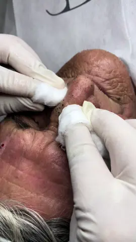 Algunas veces no es necesario utilizar agujas y tampoco sacacomedones.  La mejor opción es con las manos, el algodón húmedo nos ayuda mucho...  Es real... la extracción duele, así que las personas que han tenido acné tienen experiencia de ello... Y saben que todo es un proceso..  Se debe preparar la piel.  Estos comedones lleva  años en su piel...  En este caso el paciente tiene Favre-Racouchot.  #higienefacialprofunda #millium #comedones #pimplepop #pimples #pielsanaybonita #acne #mascarillafacial 
