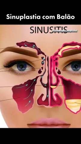 A sinuoplastia por balão é um procedimento minimamente invasivo usado para tratar sinusite crônica. Durante a sinuoplastia, um balão é inserido nas passagens nasais e inflado para alargar as vias sinuosas obstruídas, ajudando a restaurar a drenagem adequada dos seios nasais. Esse procedimento pode ser uma alternativa à cirurgia tradicional de seios paranasais em alguns casos, pois é menos invasivo e geralmente resulta em menos dor e tempo de recuperação.  #sinusite #sinusitis #fisioterapia #sinuplastiacombalão #fisio #sinuplastiaporbalão #anatomia #enfermagem #sinusitecronica 
