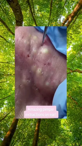 Pimple satisfying #satisfying #satisfy #satisfyingvideo #cleanTok #clean #cleaning #fyp #pimples #skincare #abscess #big #stinks #pue #blackhead #pimplesolution #acne #pimplepop #infected #acnetreatment #pointnoir #boil #cyst