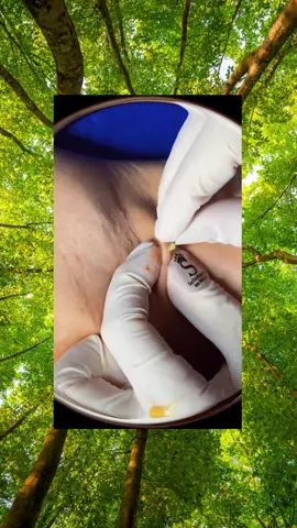 Pimple satisfying #satisfying #satisfy #satisfyingvideo #cleanTok #clean #cleaning #fyp #pimples #skincare #abscess #big #stinks #pue #blackhead #pimplesolution #acne #pimplepop #infected #acnetreatment #pointnoir #boil #cyst