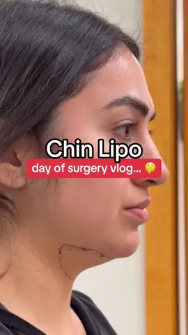Chin Lipo day of surgery vlog 😂🫶✨ comment any questions you have!  #chinlipocheck #chinlipo #doublechinremoval #chinliposuctionbeforeandafter #chinlipoupdate #chinliposurgery #chinliposuctionrecovery #doublechinlipo #clevelandchinlipo #clevelandplasticsurgeon 
