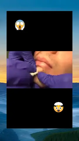 popping foryou satisfying pimpe accne pimplepop squeeze (191)