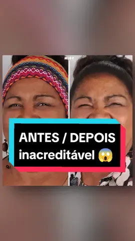 Um sorriso à medida da sua alegria, tem? 😍 Reabilitação Oral total, com a colocação de prótese fixa sobre implantes ✨ Clínica Mint - Lisboa #desdentada #toothless #sorrisonovo #womanpower #smileagain #sorriso #sorrisolindo #reabilitacao #reabilitacaooral #saudeoral #dentes #dentesbonitos #newsmile #beforeandafter #antesedepois #transformacao #transformation #clinicamint #dentistalisboa #dentistlisbon #dentist #dentistry 