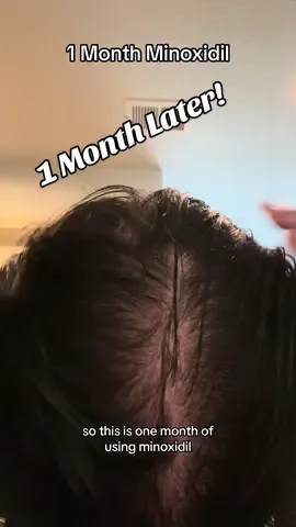 1 Month Minoxidil (+ Fin) #minoxidil #finasteride #hairgrowth  @Alan Astral 
