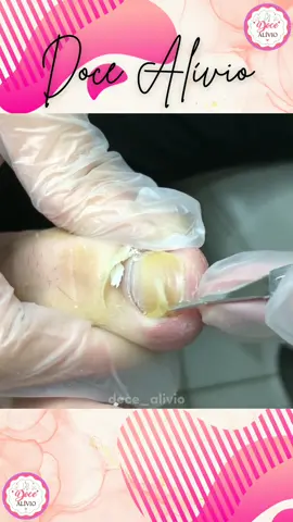 #podologia #podologa #podolog #unhas #pedicure #podologiacomamor #manicure #saude #nails #pes #podology #saudedospes #unhaencravada #pies #foot #satisfatorio #tiktokviral #fyp