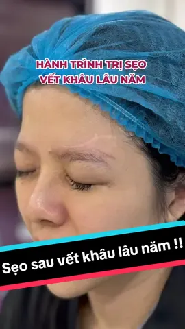 Một ca sẹo mới tại DW, cùng đón xem thành quả nhé #seo #dwdebeaute #clinic #spa #triseo #laser #laserco2 #lamdep #trending #fyp 