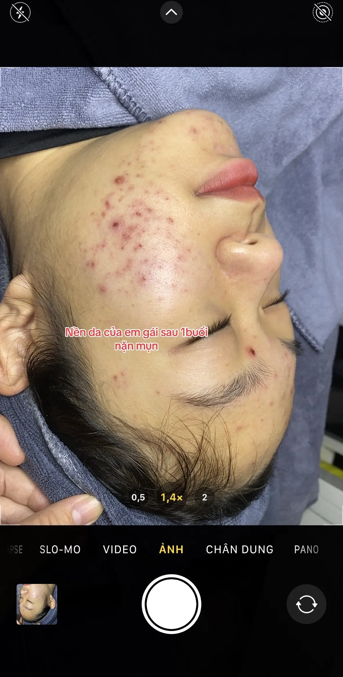 Nặn mụn bằng tay phương pháp lấy sạch nhân mụn không sưng ít đau ít để lại thâm an toàn hiệu quả #điềutrịmụn #nặn_mụn_hà_nội #nanmunbangtaysach #laynhanmun #nặn_mụn_cầu_giấy #nặn_mụn #xuhuong #HelloVietnam 