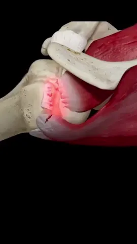 A lesão do músculo supraespinhal é uma das lesões mais comuns no ombro, especialmente em pessoas que realizam atividades que envolvem movimentos repetitivos do braço acima da cabeça, como jogadores de tênis, nadadores e levantadores de peso. A lesão pode variar de uma distensão muscular leve a uma ruptura completa do tendão. Os sintomas comuns incluem dor no ombro, especialmente durante atividades acima da cabeça, fraqueza no braço e dificuldade em levantar o braço. O diagnóstico geralmente é feito por meio de exame físico, história clínica e exames de imagem, como ressonância magnética. O tratamento inicial geralmente envolve repouso, aplicação de gelo, medicamentos anti-inflamatórios e fisioterapia para fortalecimento e reabilitação do ombro. Em casos graves, pode ser necessária cirurgia para reparar o tendão lesionado. É importante procurar atendimento médico se você suspeitar de uma lesão no supraespinhal, pois um diagnóstico precoce e um plano de tratamento adequado podem ajudar a evitar complicações e promover a recuperação completa. #manguitorotador #supraespinhal #supraespinoso #rotatorcuff #rotatorcuffinjury #fisioterapia #fisioterapeuta #fisio #fgr♿️ 