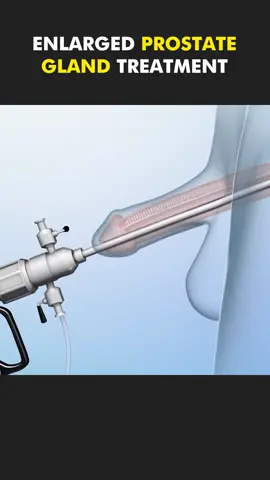 Enlarged Prostate Gland Surgery 3D Animation (Transurethral resection) #turp #transurethral #transurethralresection #enlargedprostate #prostatacancer #prostateglandsurgery #prostateenlargement #prostateproblems #medical3danimation #catheterization #maleprostatecancer #prostatehealth #treatmentofprostateenlargement #menshealthtips #menshealth 