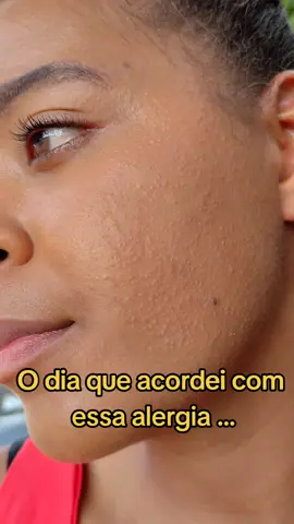 como acabar com alergia no rosto em três dias  . . .#furoatodemometasona #dicas #alergia #rostolisinho #rosto #foryou #vaiprofycaramba #explorar #dicastiktokbrasil #resenha #amiga 