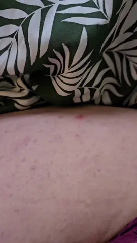 Juicy pop on my hip #pimple #pimples #fyp #pop 