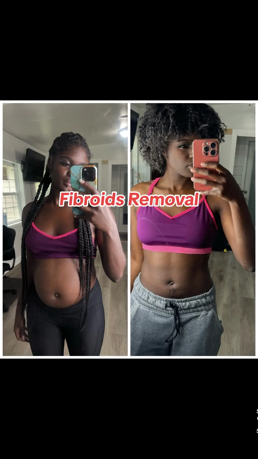 I no longer have fibroids  and wow the way I feel is incredible 🥰. I'm no longer burdened by random pain, I have more energy i don’t get tired as much my bladder is better im using the restroom regularly im greatful 🙌🏿and my periods are significantly lighter I am Grateful for a successful recovery; I used to feel like I was carrying a 3-month pregnancy due to the fibroids. They removed six, and I've dropped from 144 to 130 pounds these fibroids where 12 pounds . It's amazing to see how much this has affected me for so long and just to see how my body has change and my health is amazing thank you God and to everyone who’s been keeping me in prayers and checking on me ♥️ 4 weeks since my surgery and I feel amazing #fibroids #fibroidsurgery #foryoupage #fypシ #fibroidsrecovery #godisgood #mytestimony    