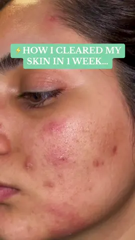 Clear skin routine✨⚡️ #foryoupage #foryou #trending #skin #skincare #clearskin #acne #acneskin #asiangirl #desi 