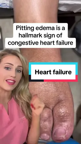 Pitting edema is often heart/kidney failure, but there are many other causes. Its important to talk to a doctor if you have this! #pittingedema #foothealth #doctorreacts #doctor #heartfailure 