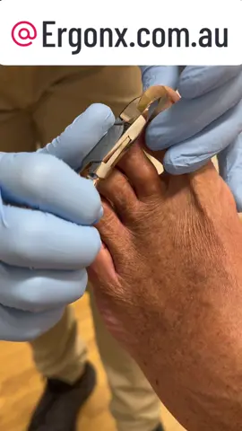 Cutting a fungal nail. Onychomycosis when we see a fungal nail in the podiatry we generally cut it back as far as possible to reduce the fungal load #ergonx  #docpods #fungal #fungalnail #nailcutting #onychomycosis 