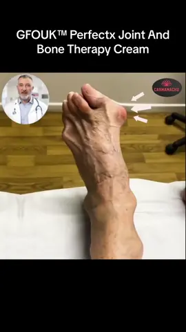 After years of struggling with bone stones, gout, joint deformities, and swollen cysts with no relief in sight, I heard about a revolutionary product promising relief. I gave it a shot and I'm so glad I did! In just a few weeks, my pain and inflammation reduced dramatically, my joint deformities were less pronounced, and I'm back to doing the things I love. This product changed my life! #BoneHealth #GoutRelief #JointDeformities #SwollenCysts #InflammationRelief #PainManagement #HealthTransformation #LifeChangingProduct #WellnessJourney #tiktoktestimonial 