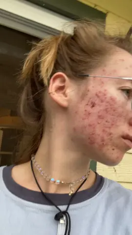 Been waiting 6 months to post this 💕🥲 #accutane #isotretinoin #acnejourney #acne #accutanecheck #beautifulthings #itgetsbetter #nofilter 