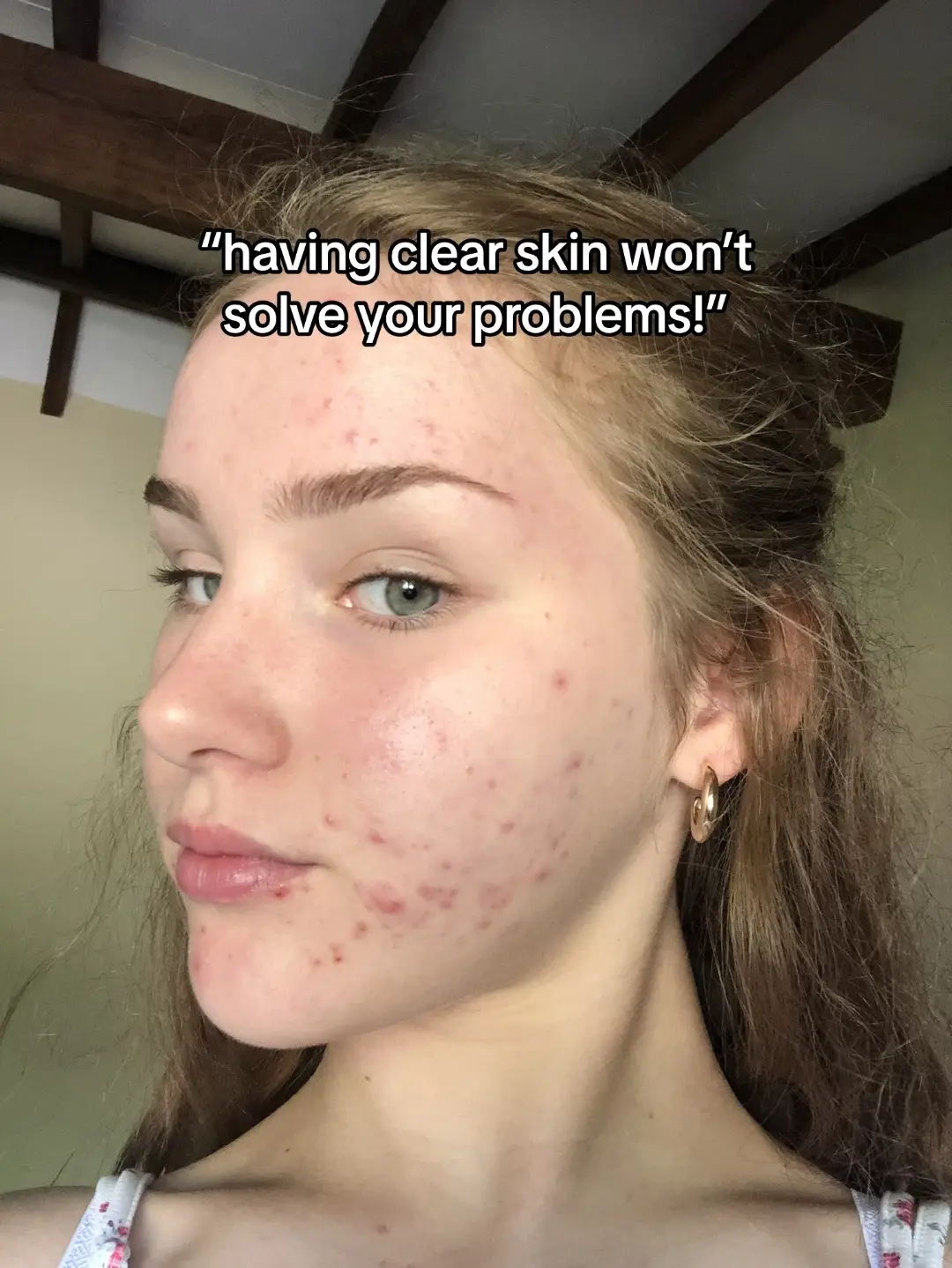 yes it will😡😡 *acne healing guides in my bio* #acne #acnerelatable #skintok #acneproneskin #fyp #acnementalhealth  #explore #clearskin 