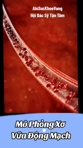 Xơ vữa động mạch là một tình trạng bệnh lý mãn tính đặc trưng bởi sự tích tụ các mảng mỡ, cholesterol và các chất khác trong động mạch. Những mảng bám này, còn được gọi là mảng xơ vữa, có thể thu hẹp và làm cứng động mạch, làm giảm lưu lượng máu đến các cơ quan.#alosuckhoevang #rohaumon #suygiantinhmach #tuyengiap #hoibacsytantam 