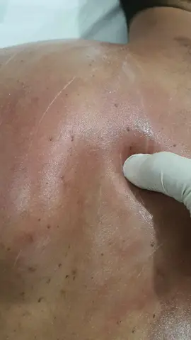 The Magical Myofascial release therapy #triggerpointtherapy #rhomboidpain 