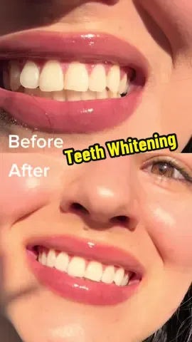 My 2024 glow up is coming ✨🙌🏼 I tested the @inopro.us whitening strips and I’m happy to report they work great! I have no sensitivity at all, which was very impressive because all the other strips i tried in the past made it so hard for me to drin water 🤣 #whiteningteeth #whiteningstrips #amazonfinds #amazonreview #glowups #whiteteeth 