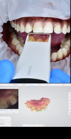 How we accomplish taking a mould of your teeth using an intra-oral scanner without the messy work of impression material. #scanner  #intraoralscanner  #intraoralscanning 