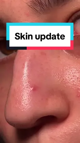 I forgot how much nose pimples hurt 🥲 #acne #hormonalacne #relatable #realskin