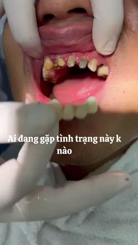 Ai đang bị tình trạng hôi miệng sau làm răng sứ thì hãy xem nha#vietkieu #nhakhoanganphuong #drtuan #rangsuthammy 
