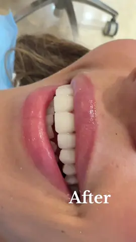 Les facettes dentaires 🦷✨🪄 #veneers 