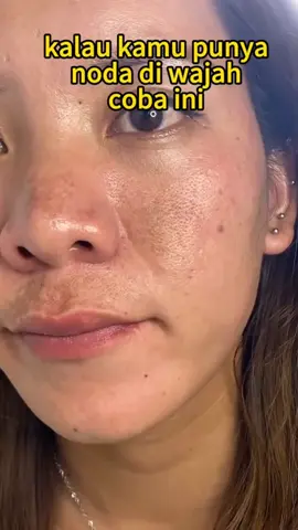 Cara Efektif hilangkan flek hitam #cindynalbpom #flekhitambandel #skincareviral #malasma #bekasjerawathitam .