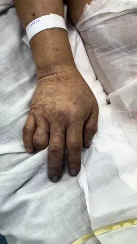 Paciente femenino, 60 años. Antecendentes de Diabetes Mellitus e infecciones urinarias a repetición . Ingresa a Emergencia con deterioro del sensorio e hipotensión arterial mientras cursaba tratamiento oral para una infección urinaria de forma ambulatoria. En sala de Emergencia la intuban, toman muestras de cultivo e inician antibióticos (Ceftriaxona) mientras espera cama en UCI. Luego de 24 horas, presenta choque refractario a vasopresores (doble vasopresor) y pasa a UCI. En UCI lo primero que hicimos fue cambiar el esquema antibiótico. Ese hallazgo es la forma visible del shunt en la microcirculación y la malaperfusión de los órganos. Preguntas, opiniones? #medicina #terapiaintensiva #uci #guardia #uci #cuidadosintensivos #sepsis #choqueséptico #septicshock #shunt #disfuncionmultiorganica #antibióticos #docencia #semiología #casosclinicos #medicinacritica 