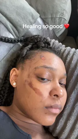 Over the weekend i took a couple of picures & videos of my face the accident friday. I havent had the energy to record any detailed video about what i use. #blackgirltiktok🤎 #fypシ゚viral #burnsurvivor #burn #healingskin #fyp #aloeverplant #neosporin #witchhazel 