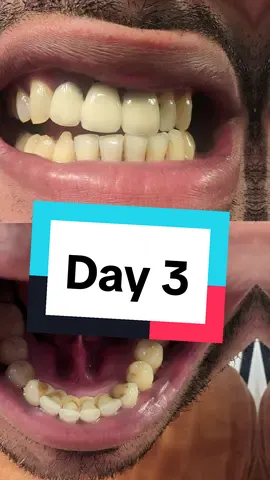 Watch my incredible journey as I transform my teeth from disgusting to dazzling, all thanks to products from the TikTok Shop! 🦷✨ From yellow and full of plaque to pearly white, these amazing products gave me results I never thought possible. Make sure to watch every video to see the before and after, and get ready to be amazed! Day 3 #TikTokShop #TeethTransformation #DentalJourney #BeforeAndAfter #SmileMakeover #DentalCare #PearlyWhites #TikTokBeauty #SelfCare #AmazingResults #dazzlingsmile 