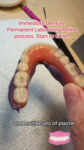 Come along while we perform the permant reline to this immediate denture. This is done at six months following the tooth extractions. This immediate denture is now converted to a permanent denture😃😃😃#denturegangnoshame #denturesgang #denturejourney #showyourteeth🦷 #fypシ #❤️❤️❤️ #expert #howitsmade #interesting #falseteeth #denturesvsfood #dentures #fyp #teeth #toothless #immediatedentures #dentallab #denturist #fabrication 