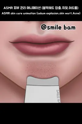 #smilebam #애니메이션 #케어 #블랙헤드 #쥐젖 #asmr #care #satisfying #blackhead #soonent