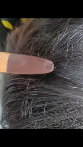 OMG 😱😱😱 đã loại bỏ chấy  #fypシ゚viral #fypシ #viral #foryou #lice #tick #fyp #liceremoval #omg 