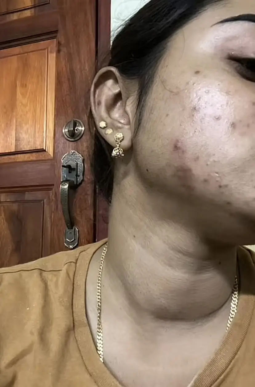 😍✨🥹acne journey watch till the end  ZAHA BEAUTY CLIENTS ❤️✨😍 🌸HAPPY WOMANS DAY 🌸 #womansday #happywomansday  #womanpower  #acnetreatment #acnecauses #acne #acneskin #skinadvice #acnejourney #zahabeauty #customerfeedback #skintransformation #zahabeautyfeedbacks #zahabeautynightcream #zahaproduction 
