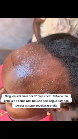 #calvice #cabelo #foryoupage #calvicefeminina #segueai @Doutor do cabelo 